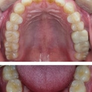 대구부분교정 치아 위생관리를 위해서도 치아교정은 중요합니다.
