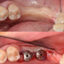 [서울삼성치과 잠실점]뼈폭이 좁은 치조골을 오스템사(Osstem)사의 에세키트(esset kit)를 이용한 릿지 스플릿 치조골이식