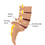 [재활/척추] 요부 통증 - 10. 척추 전방전위증(Spondylolisthesis), 척추분리증(Spondylolysis)