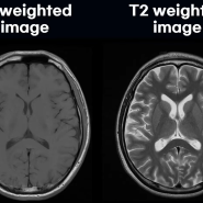 MRI T1, T2 image