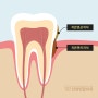 안양 잇몸치료치과, 스케일링으로 제거가 어려운 치석도 깨끗하게