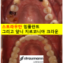 전세계 1위 스트라우만 임플란트를 사용한 어금니 기능회복과 앞니 지르코니아 크라운 증례. 신금호역 치과. 연세더좋은플란트치과.