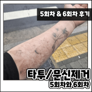 팔 타투/문신제거 5회차 그리고 6회차 고통과 비용 내돈내산 후기