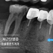 치근단 절제술 이란?