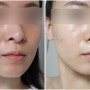 잠실피부과 텐써마 300샷 리프팅 30대 탄력고민 | 통증 가격 부작용 땅콩형 얼굴