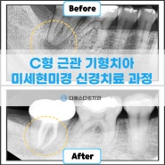 연산역치과 부산 치과보존과 전문의 기형치아 신경치료는