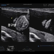 [임신21주차5일] 정밀초음파 보고온날