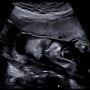 임신 일기 - 임신 6개월 : 21~24주차 증상 및 검사, 배크기, 첫 서브병원, 양수부족