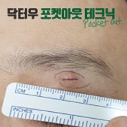 창원 피지낭종 위치에 따라 말끔하게 없애는 방법