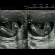 임신 15주차 16주차 임산부 증상 및 기형아 검사 성별 확인