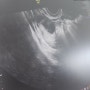 임신준비2개월차기록:배란초음파,B형간염2차접종완료