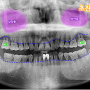 달서구 치과 임플란트 식립 전 염증은 치조골을 소실시켜 문제를 초래할 수 있습니다.