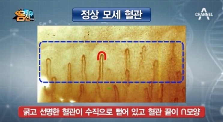 모세혈관 혈류 테스트-돌연사를 막으려면 : 네이버 블로그