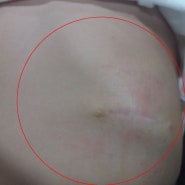 [소아흉터전문피부과]수술흉터 레이저제거,흉터관리 - 레이저와 흉터재생술
