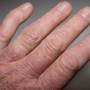 [USMLE review] Rheumatoid arthritis-2, 류마티스관절염-2