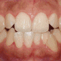 호계동 치과 삐뚠 치열 치아교정 을 통한 심미성 및 기능 개선 과정