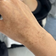 [나트랑여행기]베트남 여행 후 피부병, 당신의 팔에 얼룩점이 생겨났다면-식물성광피부염에 대하여