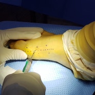발을 치료하는 정형외과, 최경진정형외과 // 무지외반증 수술은 어떻게 할까?