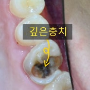 청량리 치과 깊은 충치로 통증 나타나던 치아 신경치료 과정과 주의사항