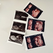 임신 초기 3개월 임신12주 목투명대 3mm 니프티검사 & 성별 각도법 일상