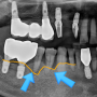 잠실 임플란트 치과, 부러진 치아, 어금니 임플란트 수술 (신뢰를 통한 진단)