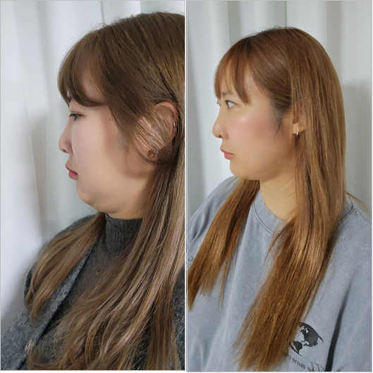 턱살지방흡입후기 5주차 효과와 턱살주사 관리 방법은? : 네이버 블로그
