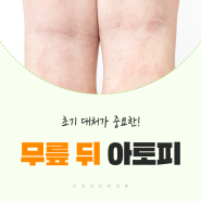 무릎뒤아토피 증상과 치료 방법은?