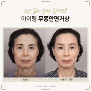 무흉안면거상으로 10년 젊어진 이유는?