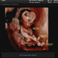 12주차 입체 초음파와 1차 기형아 검사(목투명대 두께와 코뼈) 임신중 체중증가