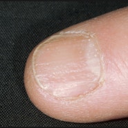 손발톱 주위염이란 무엇일까요?