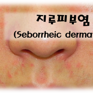 [OR] 지루 피부염(Seborrheic dermatitis)