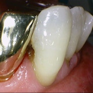 만성으로 진행된 전치부 치아우식의 치료