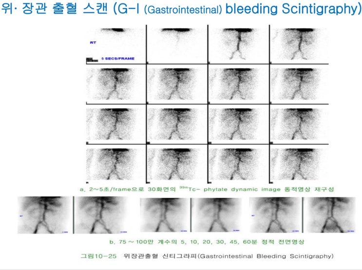 소화기계 - 위·장관 출혈 스캔(GI bleeding Scintigraphy) : 네이버 블로그