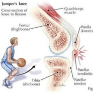 [야탑재활] 점프,달리기 후 아픈 내 무릎 슬개건염이라고?!