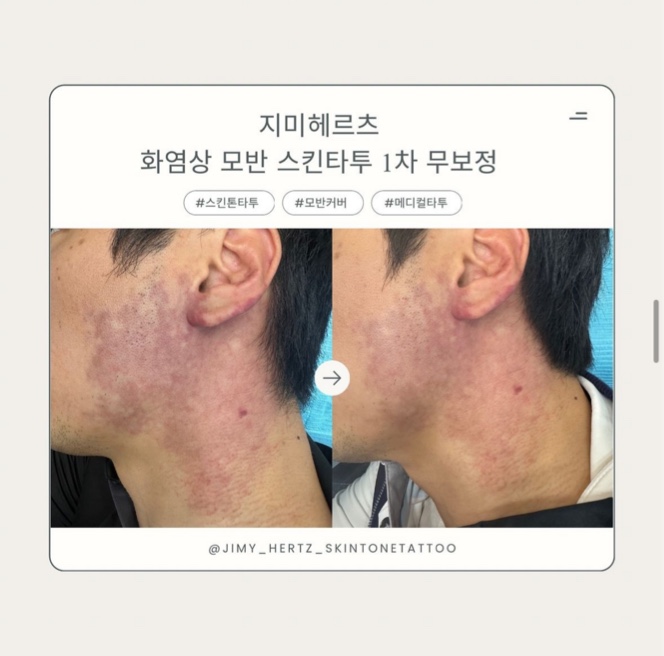 화염상 모반, 살색 스킨톤타투로 간단하게 해결해요 :) : 네이버 블로그
