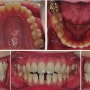 투명 치아교정에 의한 치아 벌어짐 교정