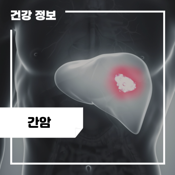 간암 초기증상 및 원인, 검사 방법, 치료, 생존율 : 3기, 4기 : 네이버 블로그
