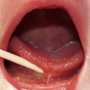 설소대 단축증이 부정교합을 일으킬 수 있다!? 치과의사가 알려주는 신생아 시기에 설소대를 시술해야하는 이유