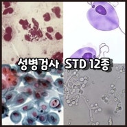 성병검사 SDT12종 소변검사 및 성병증상 확인