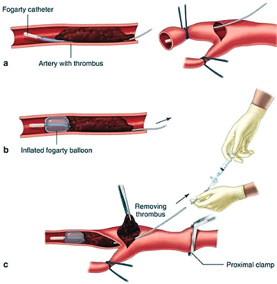 (GSV) open Thrombectomy (Lower extremities) : 네이버 블로그
