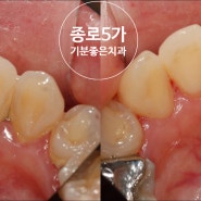 [종로 5가 치과] 1년에 한번 연1회 스케일링 놓치지 마세요!