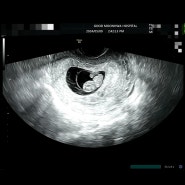 [임신 6주~8주] 심장소리와 입덧