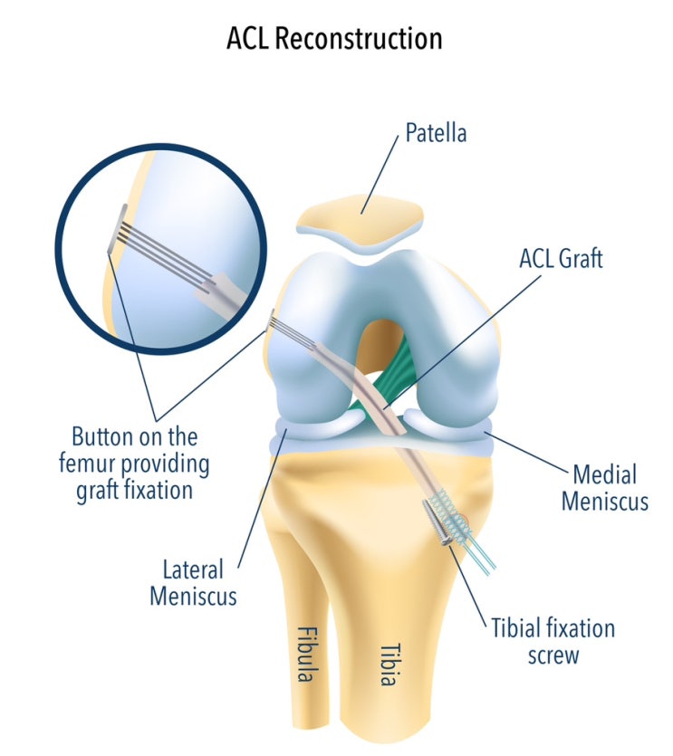 ACL reconstruction (Flipcutter)(2) : 네이버 블로그