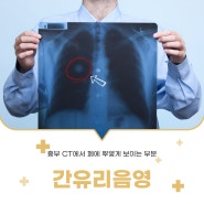 흉부 CT에서 폐에 뿌옇게 보이는 부분 간유리음영