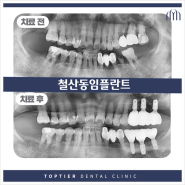 철산동임플란트 편안한 식사를 도와드리는!