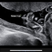 임신 22주 정밀초음파 경부길이 줄어듦 태아 크기 무게
