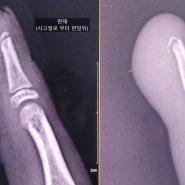 10살 여자아이 손가락 골절 및 깁스 / 김해바른정형외과