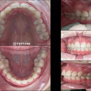 강남 치과 발치 후 치아 교정 기간 지난 뒤 유지장치 하는 이유