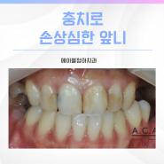 치아변색 충치로 손상심한 앞니 해결방법은?