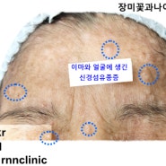 [RNN클리닉] 얼굴에 생긴 다발성 신경섬유종